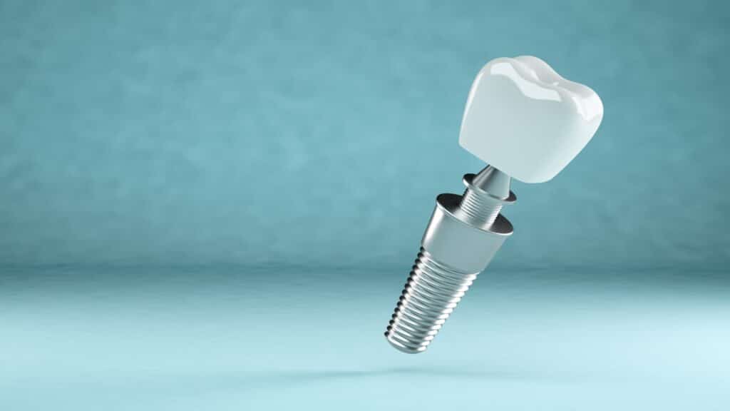 Bali Dental Implants Affordable Tooth Implants in Bali