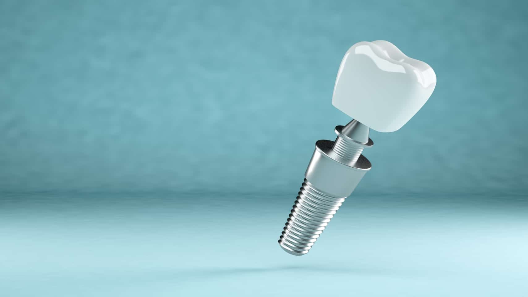 Bali Dental Implants Affordable Tooth Implants in Bali