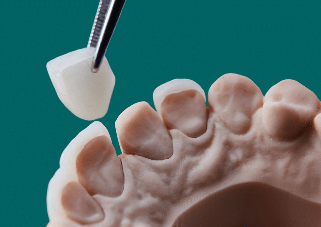 How Much Do Veneers Cost in Bali