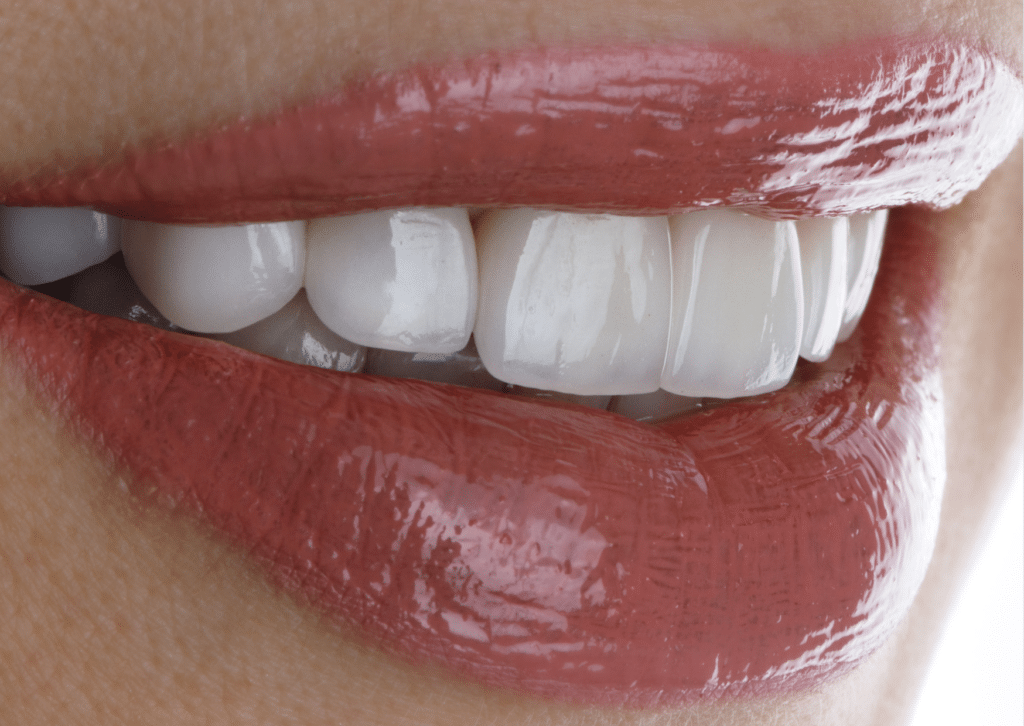 How Much Do Veneers Cost in Bali