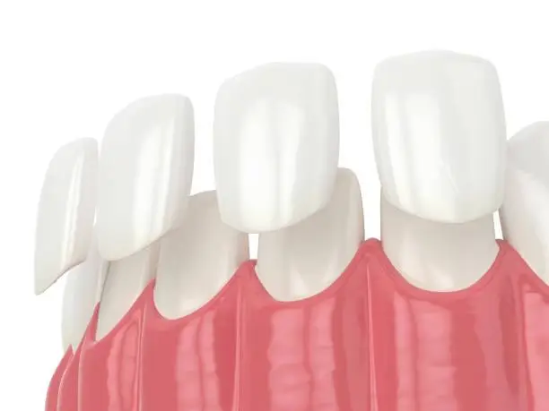 What are dental veneers
