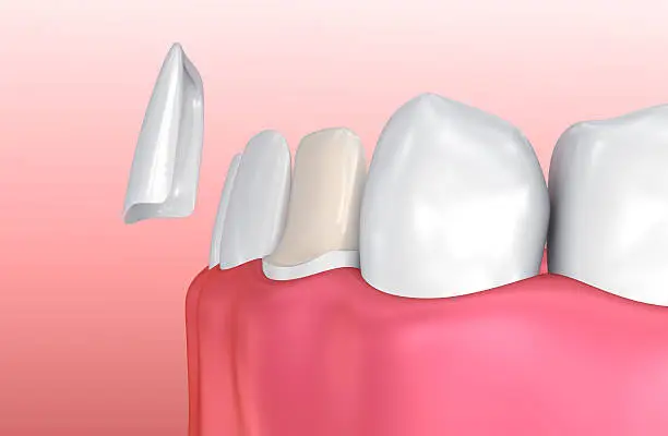 What is veneer teeth